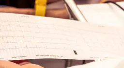 Electrocardiogram (ECG)